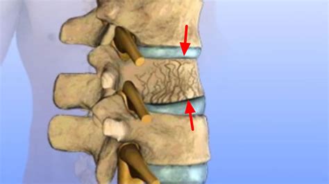 vertebral compression fracture causes